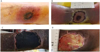 Continuous debridement combined with short-term posaconazole therapy for cutaneous mucormycosis caused by Rhizopus oryzae infection secondary to acute myeloid leukemia: a case report